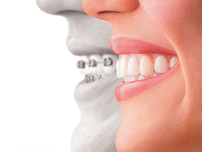 The image shows a split-screen comparison of a person s teeth before and after dental implants, with the upper half showing a wide smile and the lower half displaying a close-up of a mouth with implants.